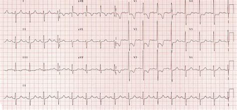 right heart strain ecg findings.